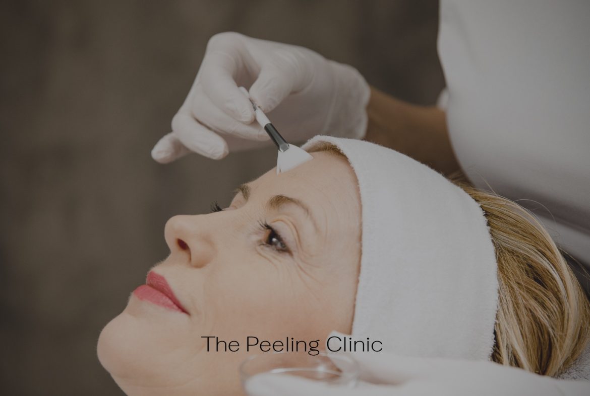 tca peeling the peeling clinic