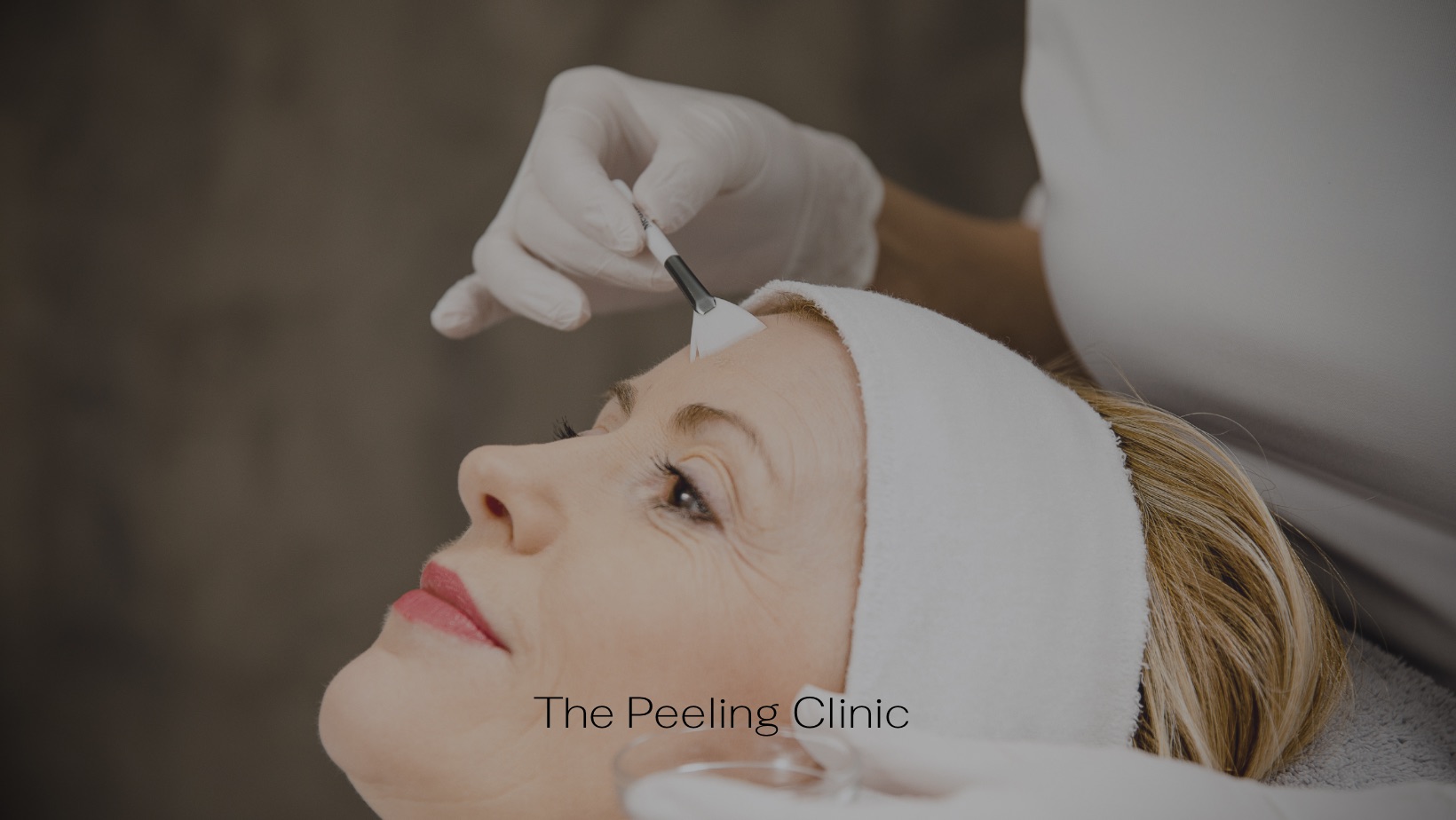 tca peeling the peeling clinic